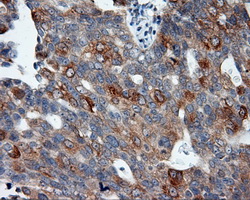 BAP / SIL1 Antibody - Immunohistochemical staining of paraffin-embedded Adenocarcinoma of ovary tissue using anti-SIL1 mouse monoclonal antibody. (Dilution 1:50).