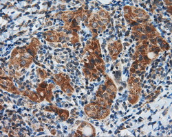 BAP / SIL1 Antibody - Immunohistochemical staining of paraffin-embedded Carcinoma of thyroid tissue using anti-SIL1 mouse monoclonal antibody. (Dilution 1:50).