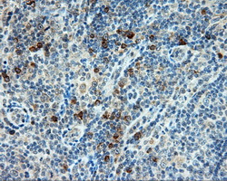 BAP / SIL1 Antibody - Immunohistochemical staining of paraffin-embedded lymphoma tissue using anti-SIL1 mouse monoclonal antibody. (Dilution 1:50).