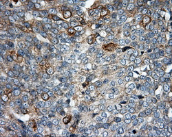 BAP / SIL1 Antibody - IHC of paraffin-embedded Adenocarcinoma of ovary tissue using anti-SIL1 mouse monoclonal antibody. (Dilution 1:50).