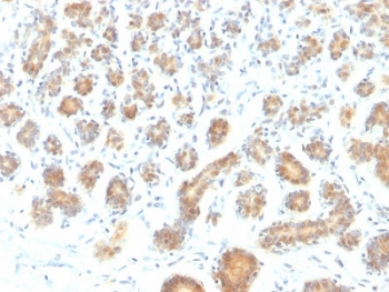 BAP1 Antibody - IHC testing of FFPE human breast carcinoma with BAP1 antibody (clone BAP1/2431). Required HIER: steam section in pH6 citrate buffer for 20 min and allow to cool prior to staining.