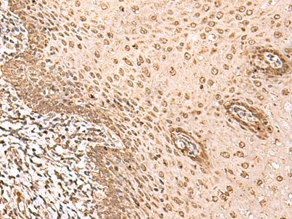 BAP1 Antibody - Immunohistochemistry of paraffin-embedded Human esophagus cancer tissue  using BAP1 Polyclonal Antibody at dilution of 1:35(×200)