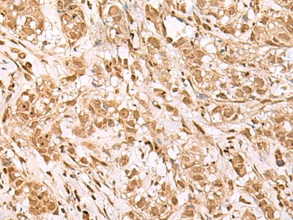 BAP1 Antibody - Immunohistochemistry of paraffin-embedded Human breast cancer tissue  using BAP1 Polyclonal Antibody at dilution of 1:35(×200)