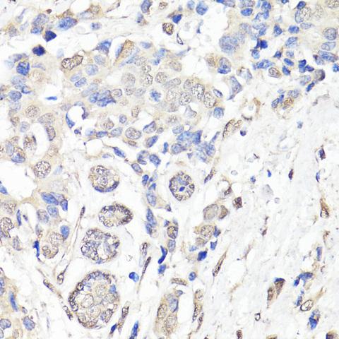 BAP1 Antibody - Immunohistochemistry of paraffin-embedded Human breast cancer using BAP1 Polyclonal Antibody at dilution of 1:150 (40x lens).
