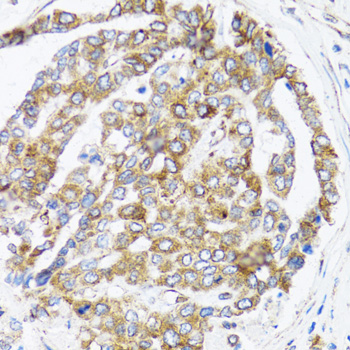 BAP29 / BCAP29 Antibody - Immunohistochemistry of paraffin-embedded human liver cancer tissue.