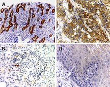 BAR / BFAR Antibody - Formalin-fixed, paraffin-embedded sections of tumor and normal human tissues stained for BAR expression using Polyclonal Antibody to BAR at 1:2000. A. Pancreatic cancer. B. Normal pancreas. C. Esophageal cancer. D. Normal esophagus. Increased expression of BAR was detected in the tumor, compared to normal tissues. Hematoxylin-Eosin counterstain.