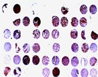 BAR / BFAR Antibody - Formalin-fixed, paraffin-embedded human prostate carcinoma tissue array stained for BAR expression using Polyclonal Antibody to BAR at 1:2000. Hematoxylin-Eosin counterstain. Variable BAR expression is seen between patient samples.