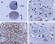 BAR / BFAR Antibody - Formalin-fixed, paraffin-embedded tissue sections stained for BAR expression using Polyclonal Antibody to BAR at 1:2000. A. Two cores from a human glioblastoma tissue microarray: 1 =fibrillary astrocytoma (grade I), and2 = anaplastic glioma (grade III). B. Higher magnification from the fibrillary astrocytoma (shown in A). C. Higher magnification from the anaplastic glioma (shown in A). D. Normal human brain striatum with positive medium spiny neurons, the major neuronal cell type of the striatum. Hematoxylin-Eos in counterstain.