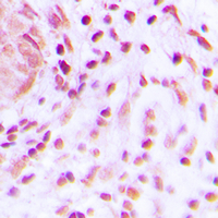 BARD1 Antibody - Immunohistochemical analysis of BARD1 staining in human lung cancer formalin fixed paraffin embedded tissue section. The section was pre-treated using heat mediated antigen retrieval with sodium citrate buffer (pH 6.0). The section was then incubated with the antibody at room temperature and detected using an HRP conjugated compact polymer system. DAB was used as the chromogen. The section was then counterstained with hematoxylin and mounted with DPX.