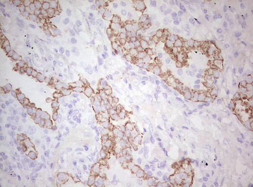 Basic Cytokeratin AE3 Antibody - Immunohistochemical staining of paraffin-embedded Carcinoma of Human lung tissue using anti-Acidic Cytokeratin mouse monoclonal antibody. (Heat-induced epitope retrieval by Tris-EDTA, pH8.0)