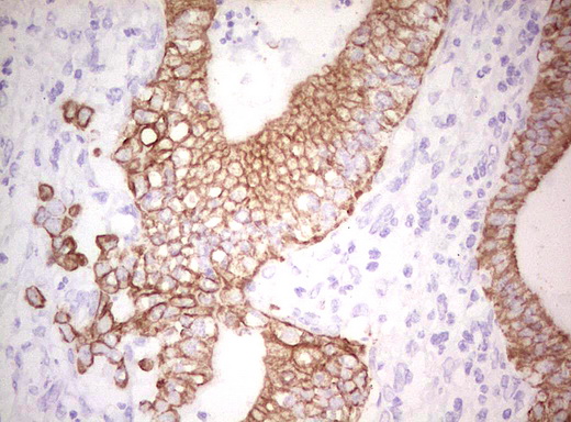 Basic Cytokeratin AE3 Antibody - Immunohistochemical staining of paraffin-embedded Carcinoma of Human pancreas tissue using anti-Acidic Cytokeratin mouse monoclonal antibody. (Heat-induced epitope retrieval by Tris-EDTA, pH8.0)