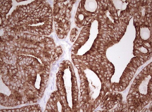 Basic Cytokeratin AE3 Antibody - Immunohistochemical staining of paraffin-embedded Carcinoma of Human thyroid tissue using anti-Acidic Cytokeratin mouse monoclonal antibody. (Heat-induced epitope retrieval by Tris-EDTA, pH8.0)
