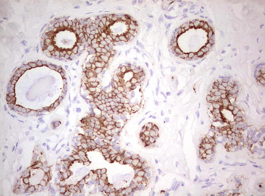 Basic Cytokeratin AE3 Antibody - Immunohistochemical staining of paraffin-embedded Adenocarcinoma of Human breast tissue using anti-Acidic Cytokeratin mouse monoclonal antibody. (Heat-induced epitope retrieval by Tris-EDTA, pH8.0)