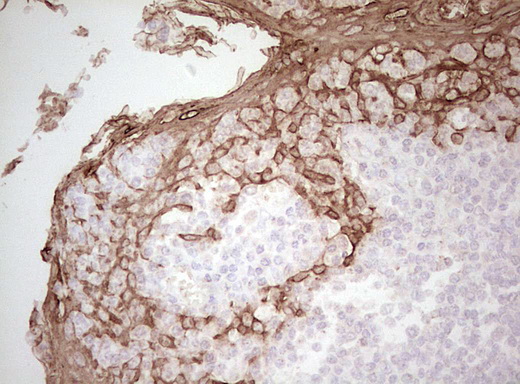 Basic Cytokeratin AE3 Antibody - Immunohistochemical staining of paraffin-embedded Human tonsil within the normal limits using anti-Acidic Cytokeratin mouse monoclonal antibody. (Heat-induced epitope retrieval by Tris-EDTA, pH8.0)