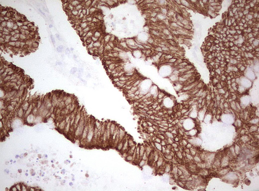 Basic Cytokeratin AE3 Antibody - Immunohistochemical staining of paraffin-embedded Adenocarcinoma of Human colon tissue using anti-Acidic Cytokeratin mouse monoclonal antibody. (Heat-induced epitope retrieval by Tris-EDTA, pH8.0)