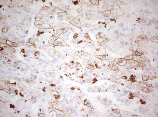 Basic Cytokeratin AE3 Antibody - Immunohistochemical staining of paraffin-embedded Carcinoma of Human liver tissue using anti-Acidic Cytokeratin mouse monoclonal antibody. (Heat-induced epitope retrieval by Tris-EDTA, pH8.0)