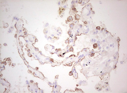 Basic Cytokeratin AE3 Antibody - Immunohistochemical staining of paraffin-embedded Human lung tissue within the normal limits using anti-Acidic Cytokeratin mouse monoclonal antibody. (Heat-induced epitope retrieval by Tris-EDTA, pH8.0)