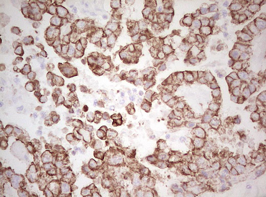 Basic Cytokeratin AE3 Antibody - IHC of paraffin-embedded Adenocarcinoma of Human ovary tissue using anti-Acidic Cytokeratin mouse monoclonal antibody. (Heat-induced epitope retrieval by Tris-EDTA, pH8.0).