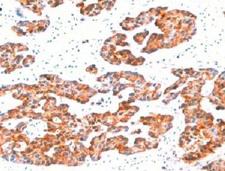 Basic Cytokeratin Antibody - IHC testing of FFPE human breast carcinoma with Basic Cytokeratin antibody (clone BCCK1-1).  This image was taken for the unmodified form of this product. Other forms have not been tested.