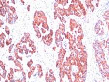 Basic Cytokeratin Antibody - IHC staining of FFPE human breast carcinoma with Basic Cytokeratin antibody (clone SPM116). HIER: boil tissue sections in pH6, 10mM citrate buffer, for 10-20 min and allow to cool before testing.