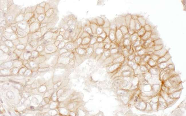 Basigin / Emmprin / CD147 Antibody - Detection of human CD147 by immunohistochemistry. Sample: FFPE section of human lung cancer. Antibody: Affinity purified rabbit anti- CD147 used at a dilution of 1:1,000 (1µg/ml). Detection: DAB. Counterstain: Hematoxylin (blue).