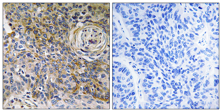 Basigin / Emmprin / CD147 Antibody - Immunohistochemistry analysis of paraffin-embedded human breast carcinoma tissue, using CD147 Antibody. The picture on the right is blocked with the synthesized peptide.