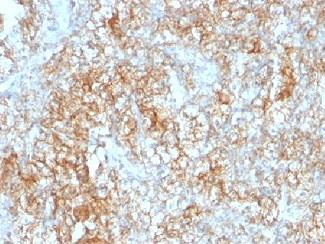 Basigin / Emmprin / CD147 Antibody - IHC testing of FFPE human renal cell carcinoma with CD147 antibody (clone 8D6). This image was taken for the unmodified form of this product. Other forms have not been tested.