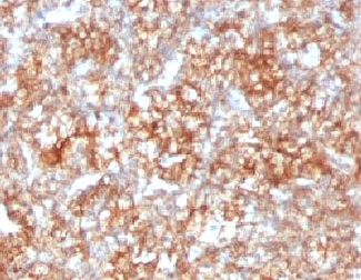 Basigin / Emmprin / CD147 Antibody - IHC testing of FFPE human renal cell carcinoma with CD147 antibody (clone CDLA147).