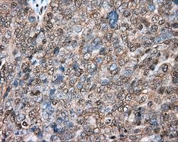 Basigin / Emmprin / CD147 Antibody - IHC of paraffin-embedded Adenocarcinoma of ovary tissue N93ing anti-BSG mouse monoclonal antibody. (Dilution 1:50).