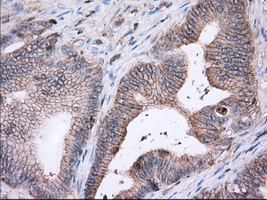 Basigin / Emmprin / CD147 Antibody - IHC of paraffin-embedded Adenocarcinoma of Human colon tissue using anti-BSG mouse monoclonal antibody. (Dilution 1:50).