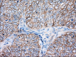 Basigin / Emmprin / CD147 Antibody - IHC of paraffin-embedded Adenocarcinoma of Human ovary tissue using anti-BSG mouse monoclonal antibody. (Dilution 1:50).