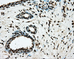 Basigin / Emmprin / CD147 Antibody - IHC of paraffin-embedded Carcinoma of Human prostate tissue using anti-BSG mouse monoclonal antibody.