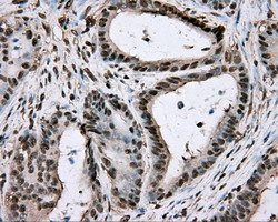 Basigin / Emmprin / CD147 Antibody - IHC of paraffin-embedded Adenocarcinoma of Human colon tissue using anti-BSG mouse monoclonal antibody.