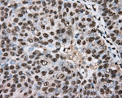 Basigin / Emmprin / CD147 Antibody - IHC of paraffin-embedded Adenocarcinoma of Human ovary tissue using anti-BSG mouse monoclonal antibody.