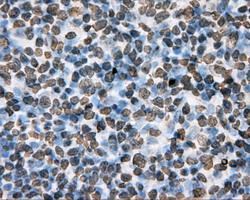Basigin / Emmprin / CD147 Antibody - IHC of paraffin-embedded Human lymphoma tissue using anti-BSG mouse monoclonal antibody.