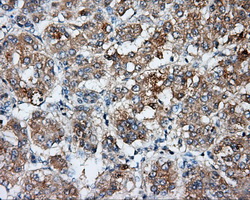 Basigin / Emmprin / CD147 Antibody - IHC of paraffin-embedded Carcinoma of liver tissue using anti-BSG mouse monoclonal antibody. (Dilution 1:50).
