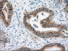 Basigin / Emmprin / CD147 Antibody - Immunohistochemical staining of paraffin-embedded Adenocarcinoma of Human colon tissue using anti-BSG mouse monoclonal antibody.