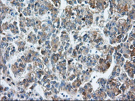 Basigin / Emmprin / CD147 Antibody - Immunohistochemical staining of paraffin-embedded Carcinoma of Human liver tissue using anti-BSG mouse monoclonal antibody.