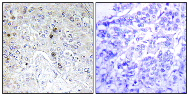 BATF Antibody - Immunohistochemistry analysis of paraffin-embedded human breast carcinoma tissue, using BATF Antibody. The picture on the right is blocked with the synthesized peptide.