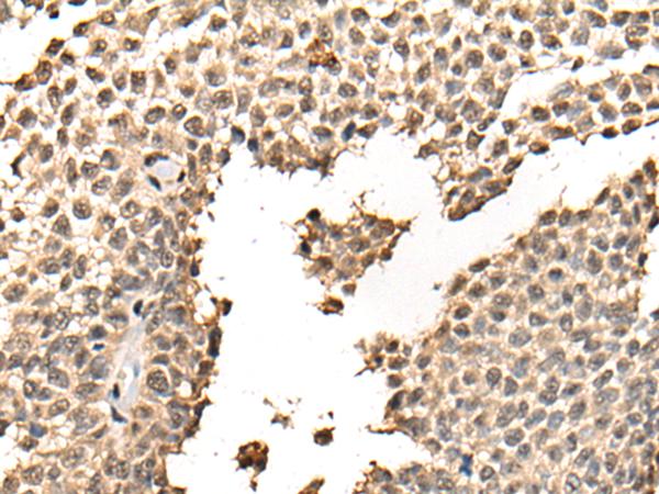 BATF Antibody - Immunohistochemistry of paraffin-embedded Human ovarian cancer tissue  using BATF Polyclonal Antibody at dilution of 1:40(×200)