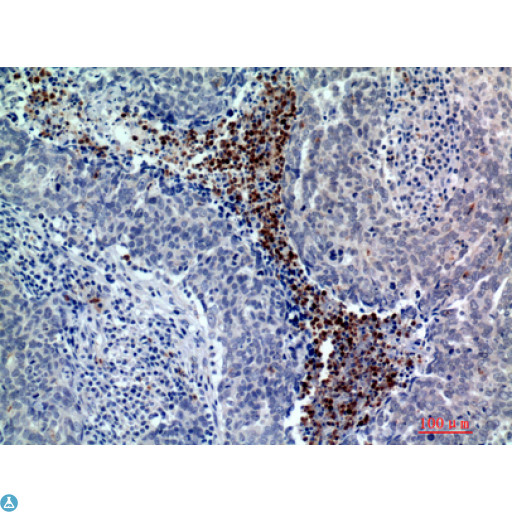 BATF3 Antibody - Immunohistochemistry (IHC) analysis of paraffin-embedded Human Breast Cancer, antibody was diluted at 1:200.