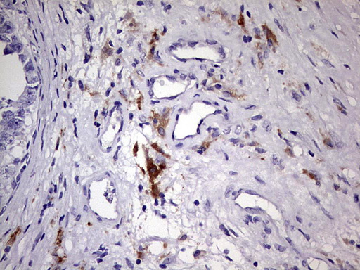 BAX Antibody - IHC of paraffin-embedded Human testicular cancer tissue using Rabbit polyclonal anti-BAX antibody at (Heat-induced epitope retrieval by 1 mM EDTA in 10mM Tris, pH8.5, 120°C for 3min).