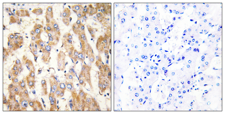 BAX Antibody - Immunohistochemistry analysis of paraffin-embedded human liver carcinoma, using BAX Antibody. The picture on the right is blocked with the synthesized peptide.