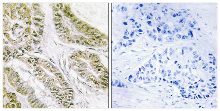 BAX Antibody - Immunohistochemistry analysis of paraffin-embedded human lung carcinoma tissue, using BAX Antibody. The picture on the right is blocked with the synthesized peptide.