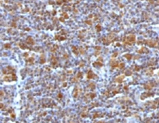 BAX Antibody - IHC testing of FFPE Hodgkin's Lymphoma with Bax antibody (clone ARBX-1).  This image was taken for the unmodified form of this product. Other forms have not been tested.