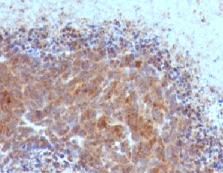 BAX Antibody - IHC testing of FFPE human melanoma with Bax antibody (clone ARBX-1).  This image was taken for the unmodified form of this product. Other forms have not been tested.