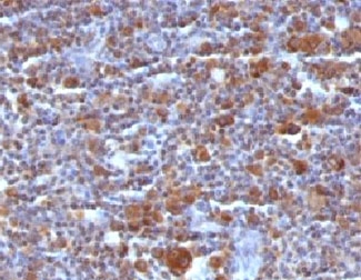 BAX Antibody - Formalin-fixed, paraffin-embedded Hodgkin's lymphoma stained with Bax antibody (BAX/962).  This image was taken for the unmodified form of this product. Other forms have not been tested.