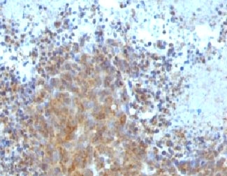 BAX Antibody - Formalin-fixed, paraffin-embedded human melanoma stained with Bax antibody (BAX/962).  This image was taken for the unmodified form of this product. Other forms have not been tested.