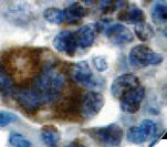 BAX Antibody - IHC of Bax on FFPE Hodgkinâ€™s Lymphoma tissue.