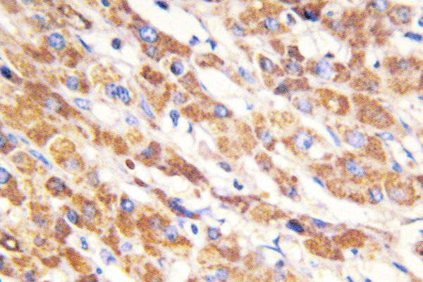 BAX Antibody - IHC of Bax (C62) pAb in paraffin-embedded human liver carcinoma tissue.